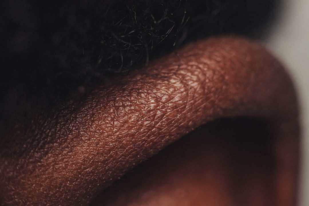 Pores dilatés
